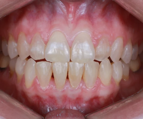 After (35)