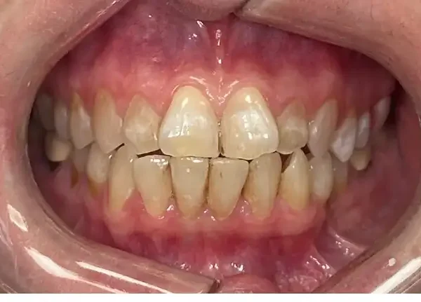 Before (32)