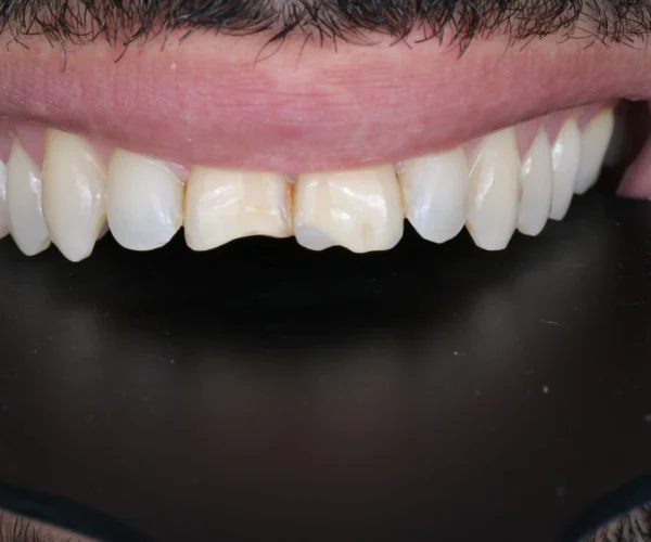 Before